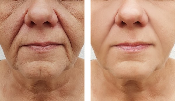 Learn more about Morpheus8 Treatment Berkhamsted today!