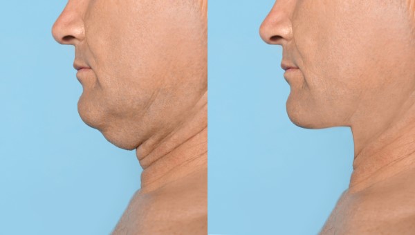 Which Non-Surgical Treatments Work Best for Jowls and Loose Skin Berkhamsted?