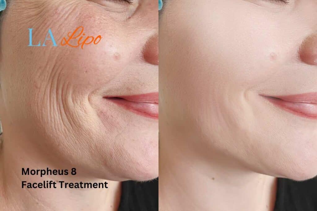 Morpheus8 Treatment Berkhamsted for flawless skin! Call us today!