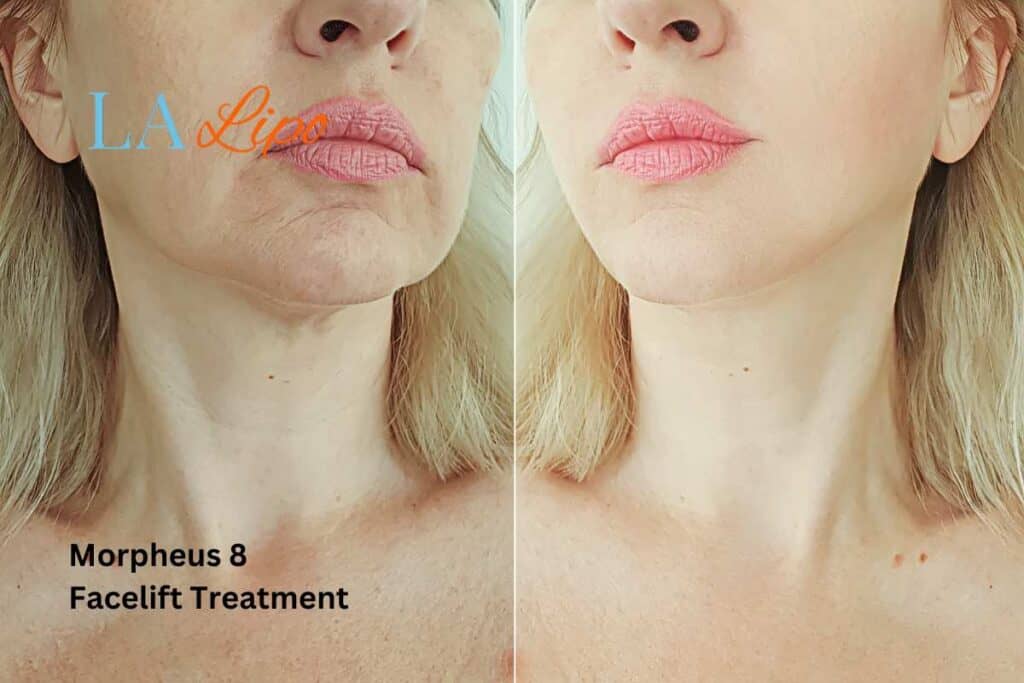 Turn back time with Morpheus8 Treatment Berkhamsted