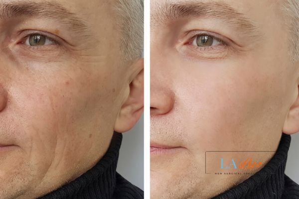 See the amazing results of Morpheus8 Treatment Berkhamsted!