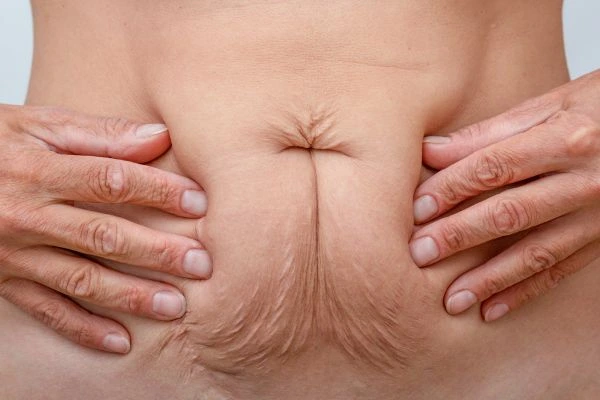 Should I Combine Diastasis Recti Treatment with Body Contouring for Better Results Berkhamsted?