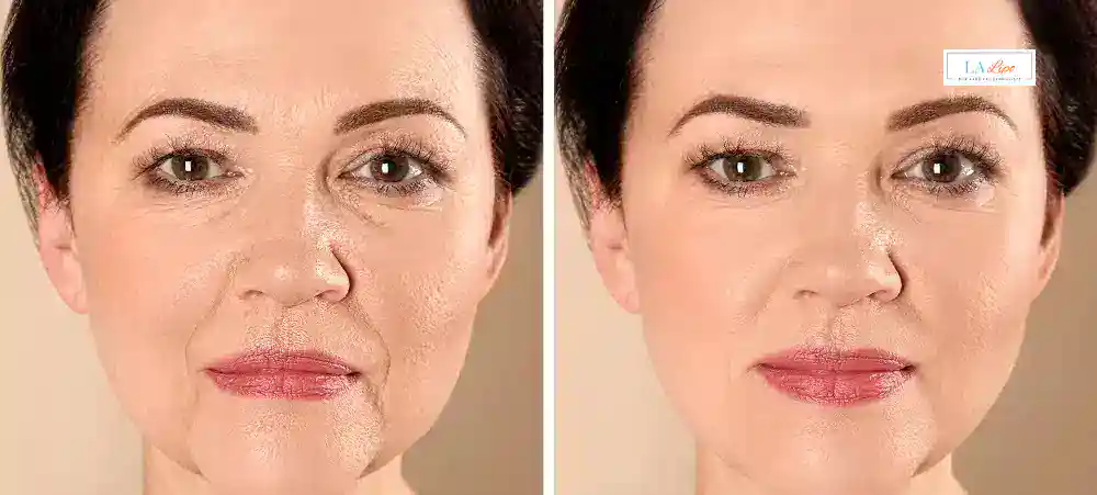 How Long Does It Take to See Results and How Long Do They Last Berkhamsted?